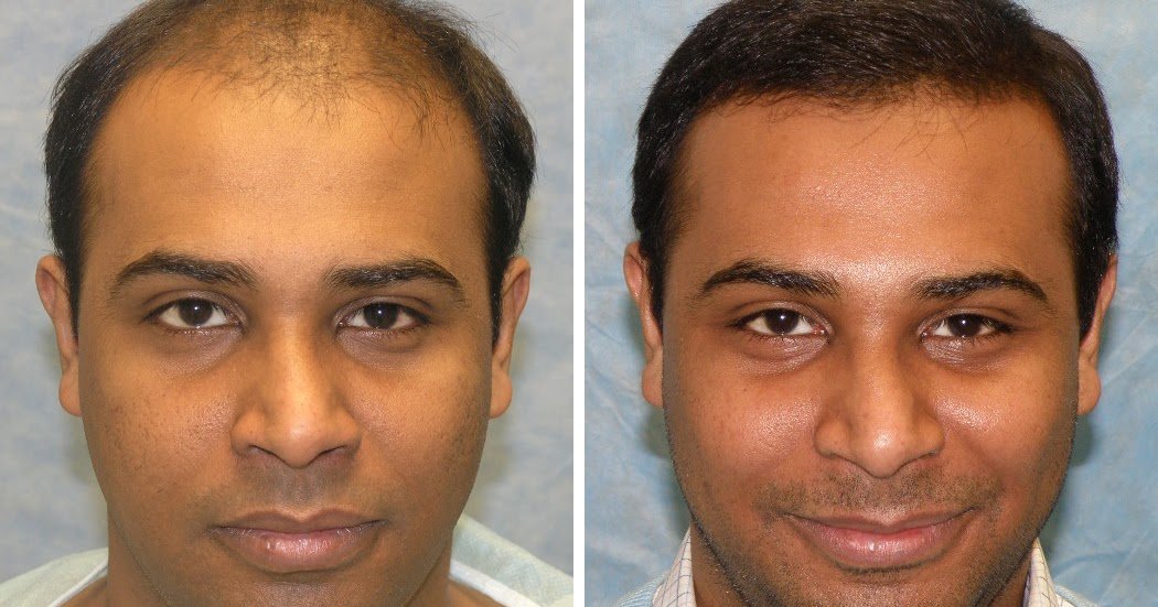 Are You Embarrassed By Your Cost Of Hair Transplantation ...